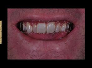 Visualizing treatment for smile design -TandCity