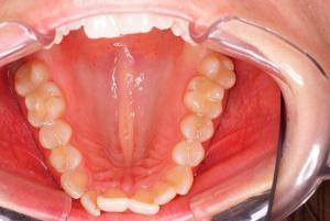 Before treatment with Invisalign for the lower jaw - TandCity