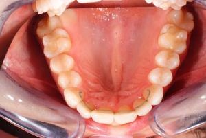 Efter behandling med Invisalign för underkäken - TandCity