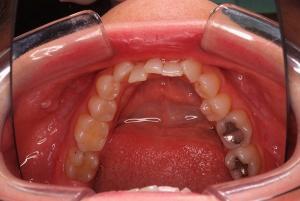 Before treatment with Invisalign for the upper jaw - TandCity