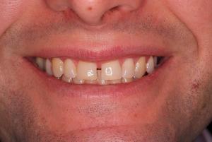 Before treatment porcelain veneers - TandCity