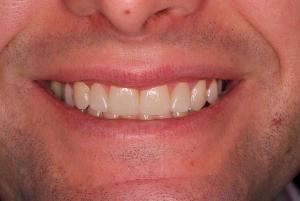 After treatment porcelain veneers -TandCity