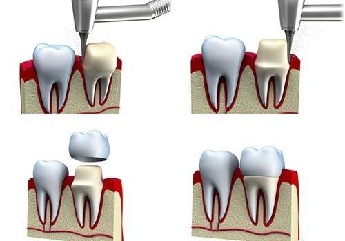 dental-crown1 dental-crown1
