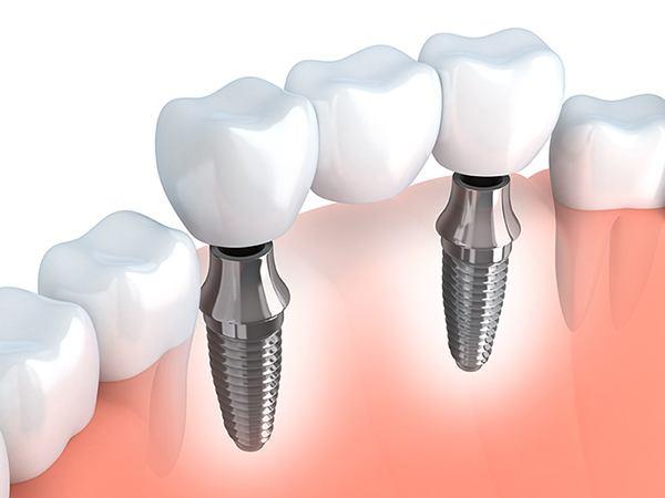 Book an appointment for professional dental implants in Malmö - TandCity