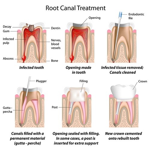 Root filling - TandCity in Malmö