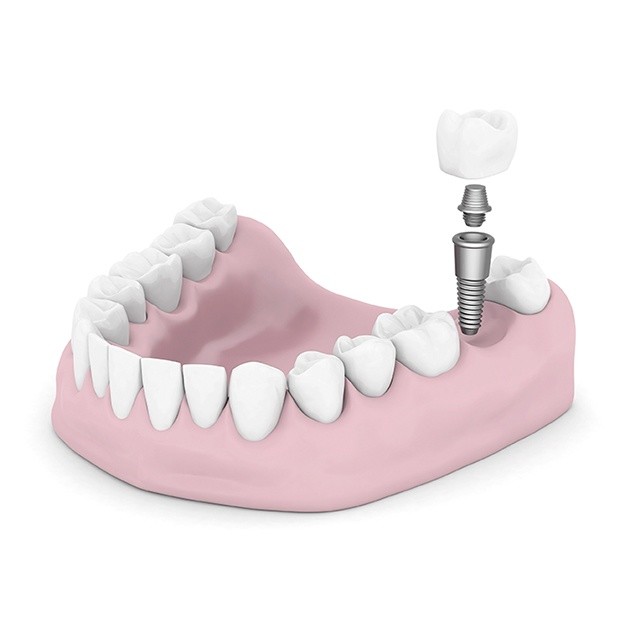 Replace a missing tooth with dental implants in Malmö - TandCity