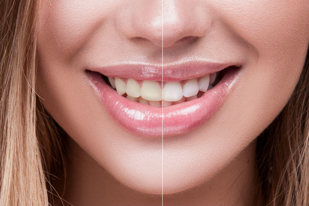 Teeth whitening treatment in Malmö -TandCity