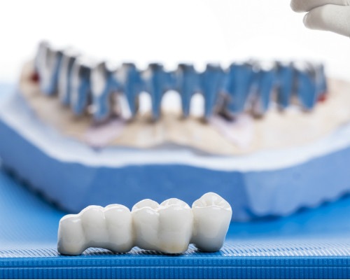 Get help with ceramic dental crowns in Malmö -TandCity