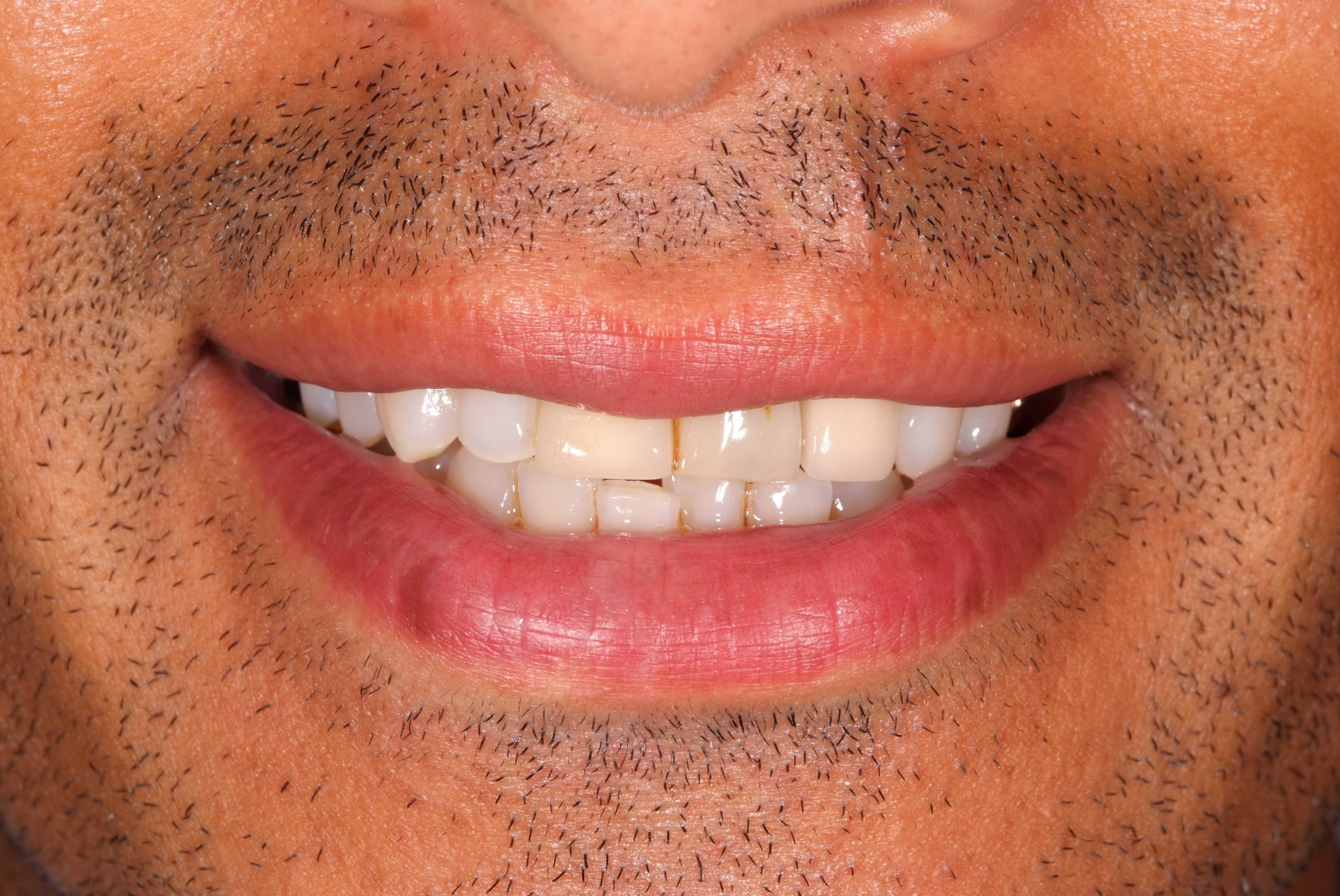 Smile-Styling before