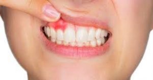 Tooth loss (periodontitis) – Symptoms